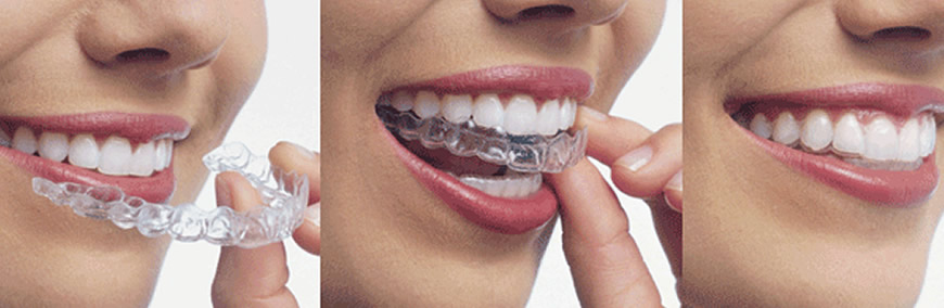 Invisalign clear removable aligners